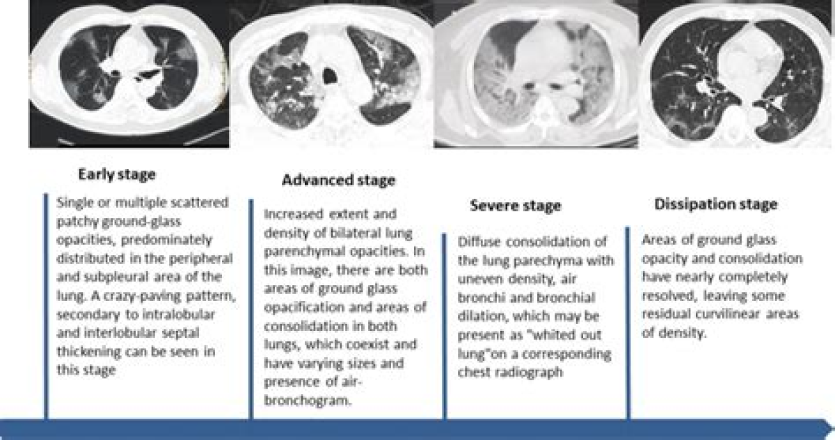 The pathophysiology of bronchiectasis