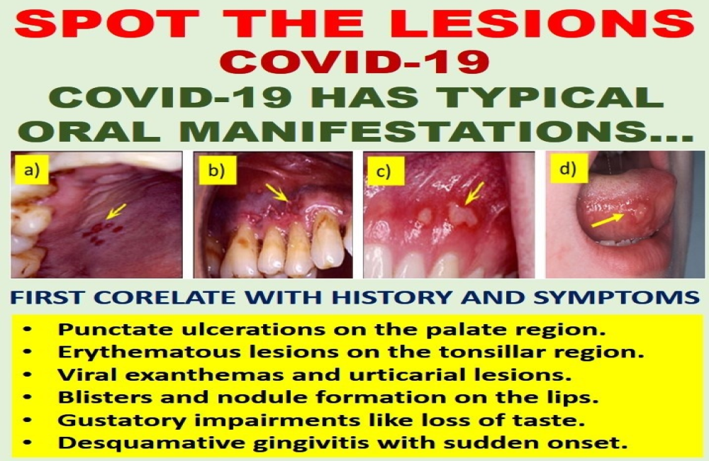 Coronavirus: are mouth lesions another Covid-19 symptom?