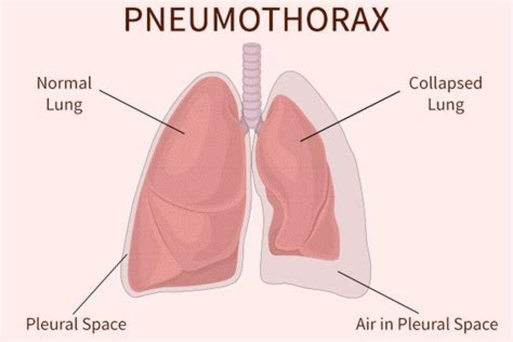 The incidence, clinical characteristics, and outcomes of pneumothorax in hospitalized COVID-19 patients: A systematic review